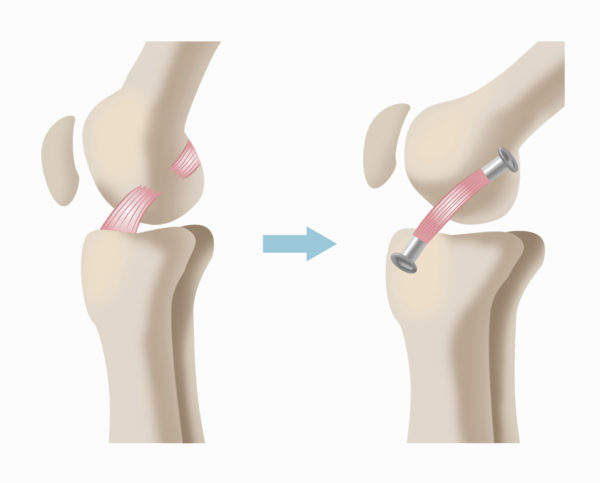 膝前十字靭帯損傷とは ひざ 関節治療オンライン