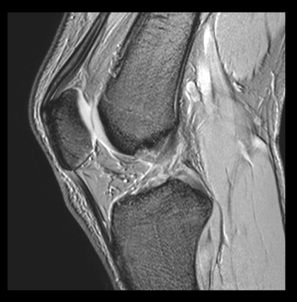 ひざの前面が痛む 膝蓋腱炎 ジャンパー膝 を医師が解説 関節治療オンライン