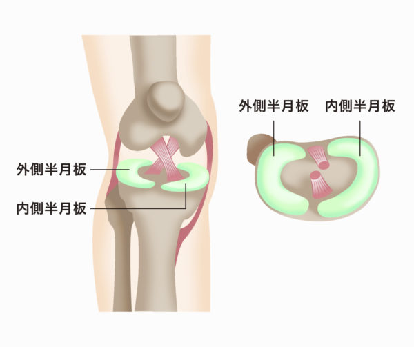 半月板損傷とは 症状や原因と 注射による治療について医師が解説 ひざ 関節治療オンライン