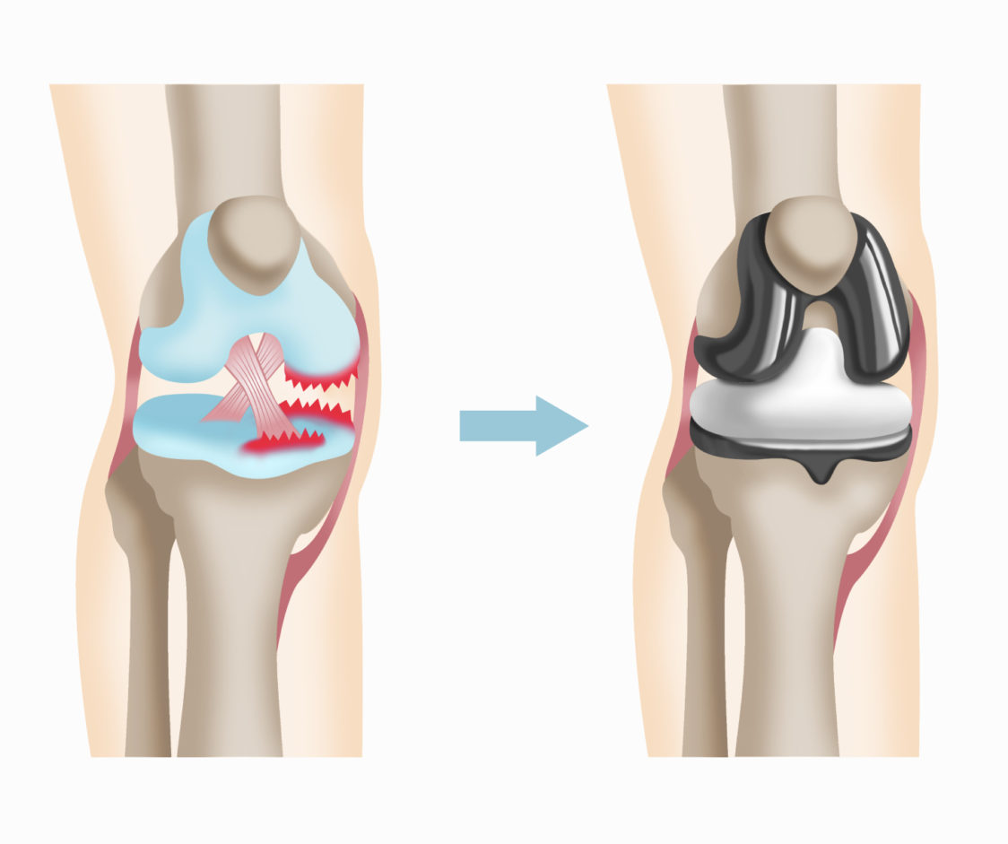 人工膝関節置換術後のリスクや生活での心がけについて医師が解説します