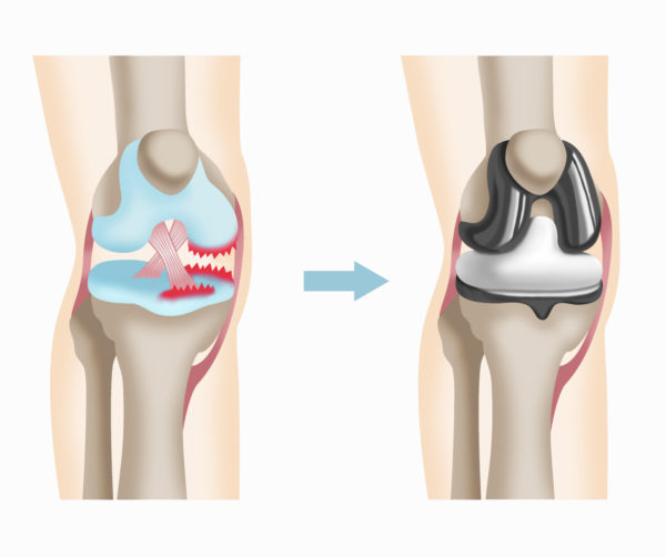 人工膝関節全置換術後の運動療法 - 健康/医学