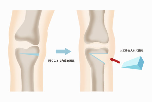 変形性膝関節症に対する治療の種類について ひざ 関節治療オンライン