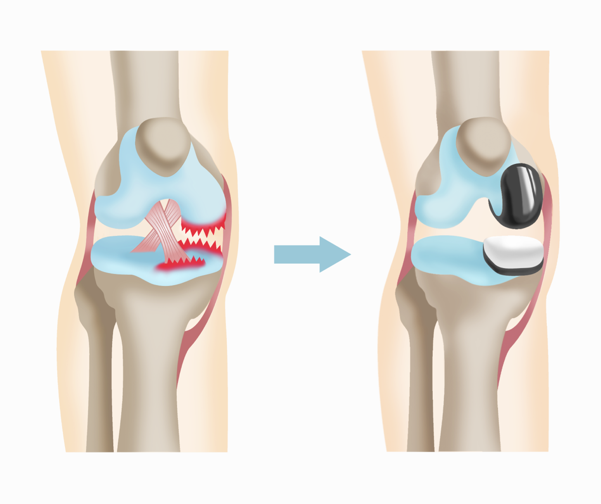 人工膝関節置換術とは｜種類や適応目安について医師が解説 | 関節治療
