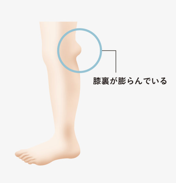 膝の裏に痛みを感じるベーカー嚢腫 のうしゅ とは ひざ 関節治療オンライン