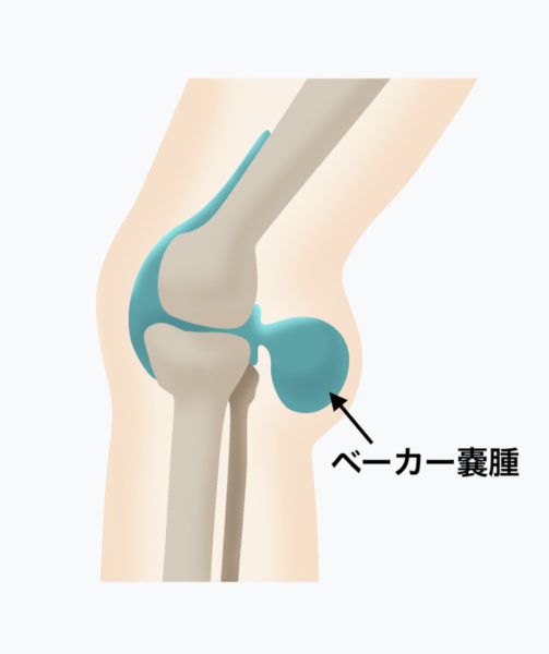 膝の裏に痛みを感じるベーカー嚢腫 のうしゅ とは 医師が解説します 関節治療オンライン
