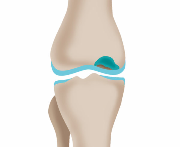 階段で膝が痛いときの代表的な疾患一覧 ひざ 関節治療オンライン