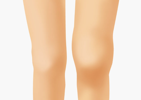 変形性膝関節症の病態 症状 を医師が解説します ひざ 関節治療オンライン