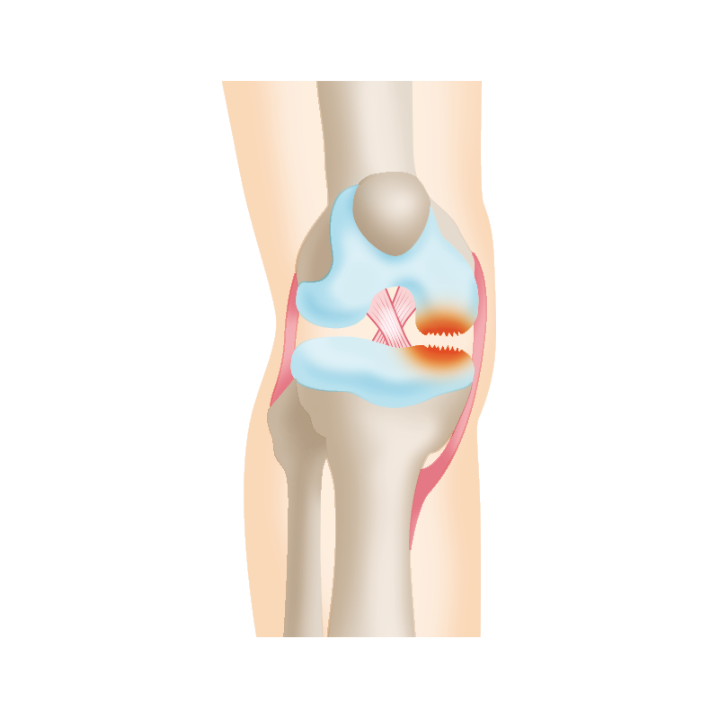 変形性膝関節症 Ggykイラスト 関節治療オンライン