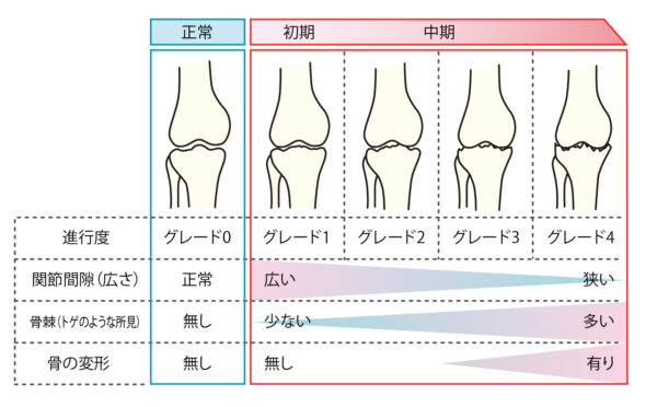 変形性関節症とは何ですか?