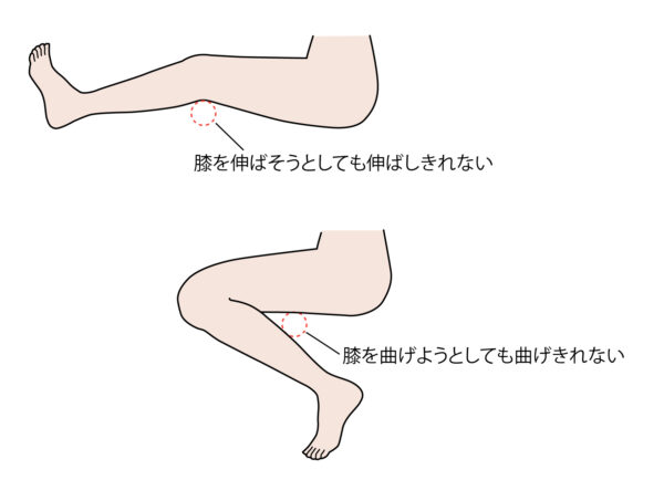 変形性膝関節症の症状とは｜初期〜末期の特徴を医師が解説 