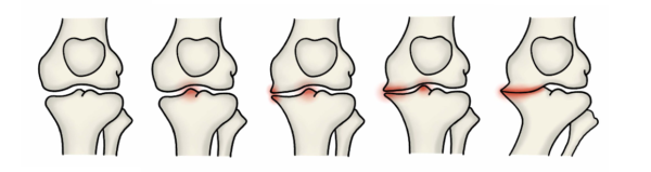 変形性膝関節症_ステージ分類_進行度イメージ