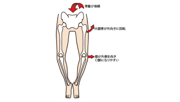 変形性膝関節症　O脚