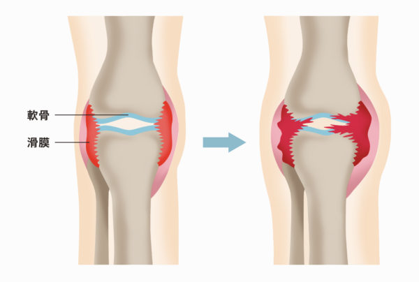 膝が痛い 膝を曲げると痛む5つの代表的な疾患を医師が紹介します 関節治療オンライン