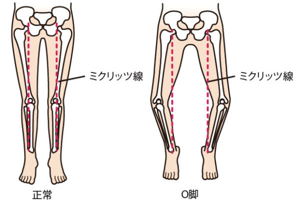 正常な脚とO脚の場合のミクリッツ線（体重がかかる軸）