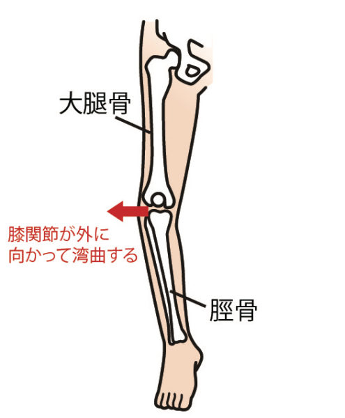 変形性膝関節症になりやすいo脚 そのセルフチェックや注意点 関節治療オンライン