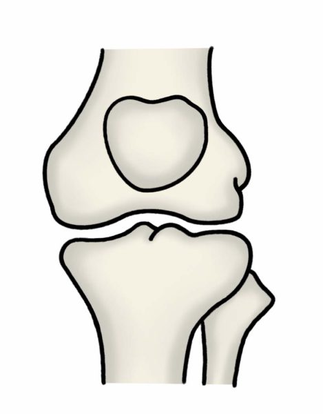 変形性膝関節症グレード0の膝関節の様子