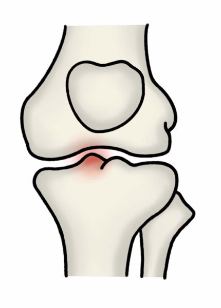 変形性膝関節症グレード1の膝関節の様子