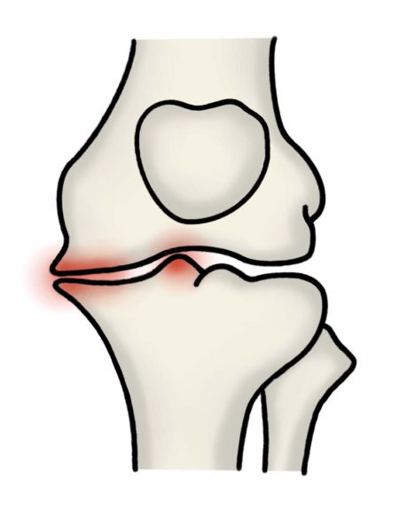 変形性膝関節症グレード3の膝関節の様子