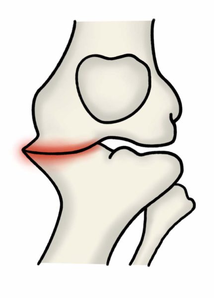 変形性膝関節症グレード4の膝関節の様子
