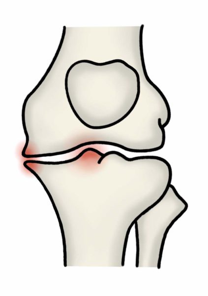 変形性膝関節症グレード2の膝関節の様子
