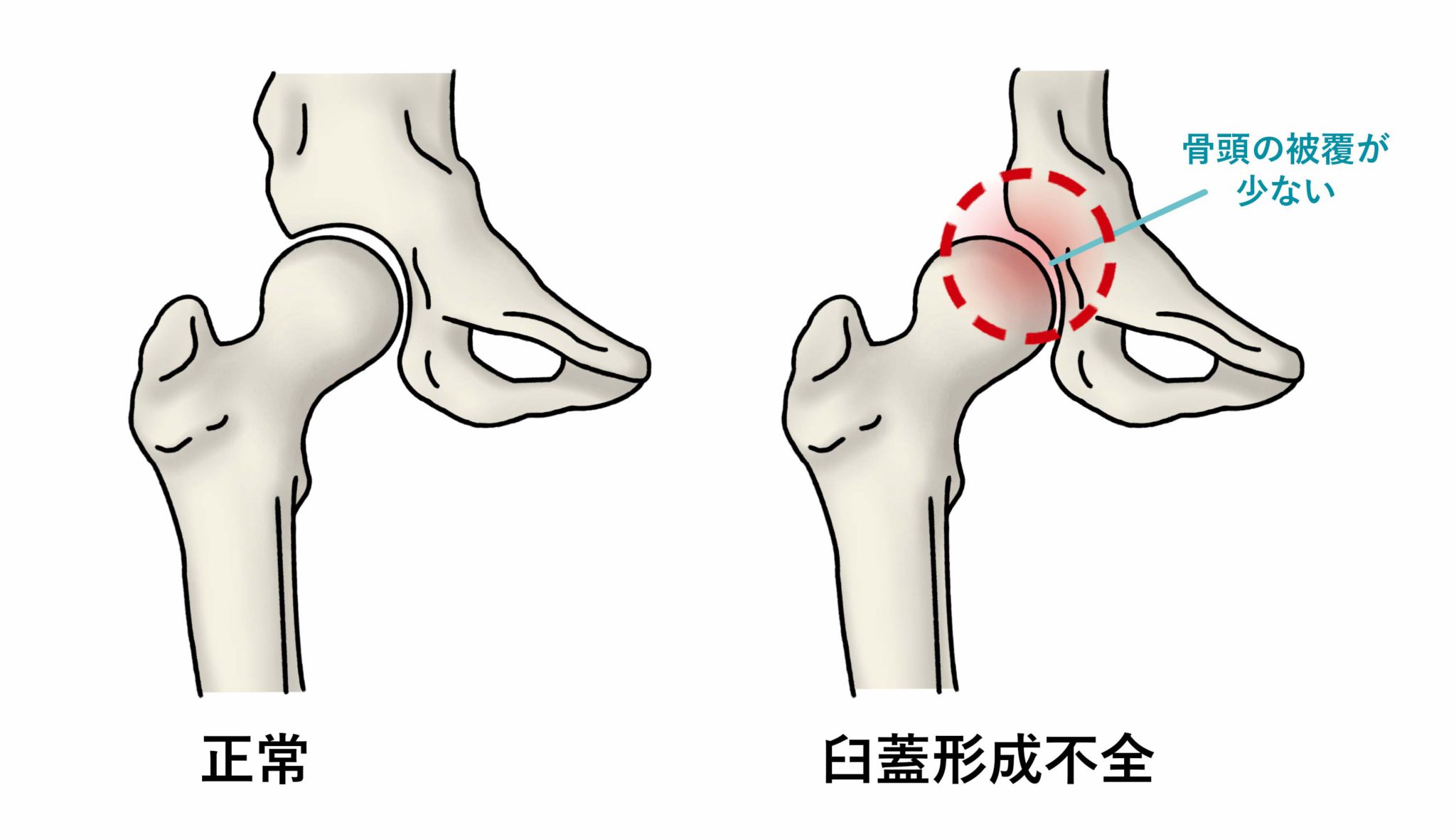 変形性関節症とは何ですか?