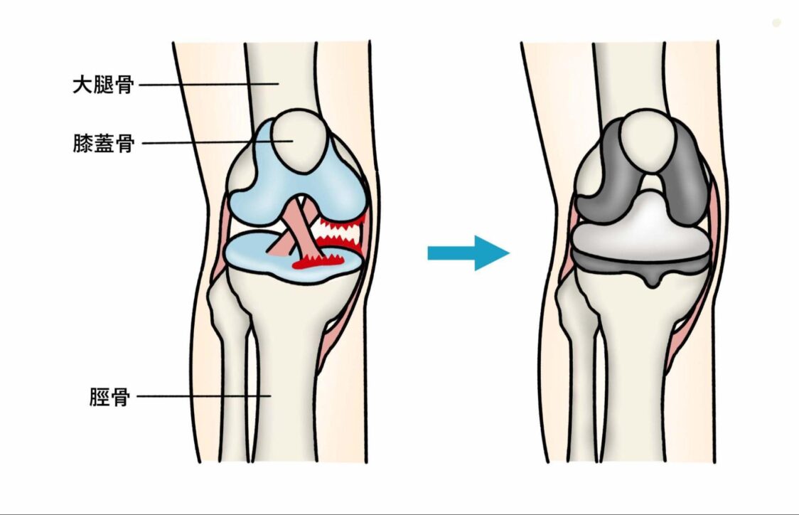 膝関節の手術